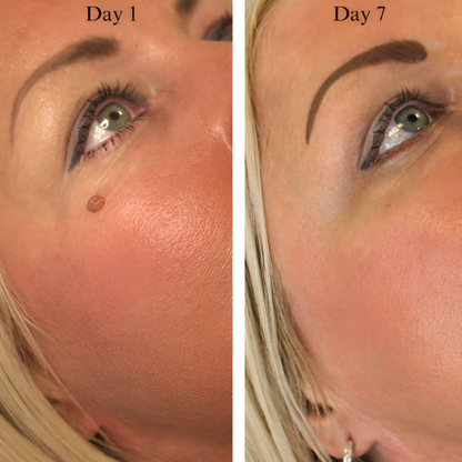 TagBeGone™ – Easy Skin Tag Removal
