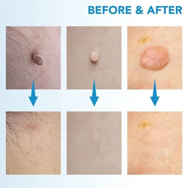 TagBeGone™ – Easy Skin Tag Removal