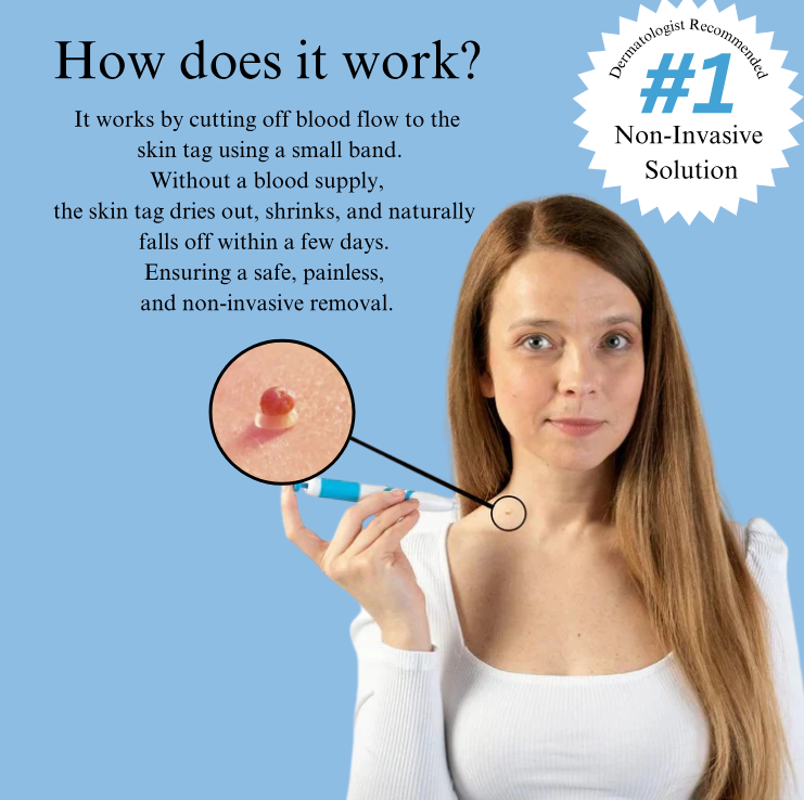 TagBeGone™ – Easy Skin Tag Removal
