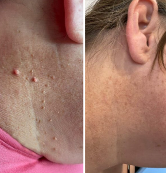 TagBeGone™ – Easy Skin Tag Removal