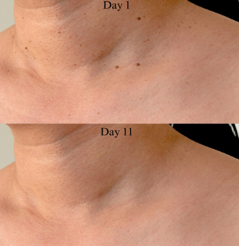 TagBeGone™ – Easy Skin Tag Removal